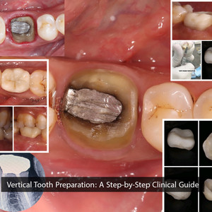 The 【裁断済】 Tooth Preparation